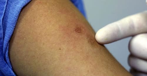 SEDES CONFIRMA DOS CASOS DE VIRUELA SÍMICA EN LA PAZ Y ACTIVA ALERTA EPIDEMIOLÓGICA